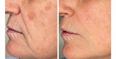 Laser handpiece positioned near a client's cheek during treatment