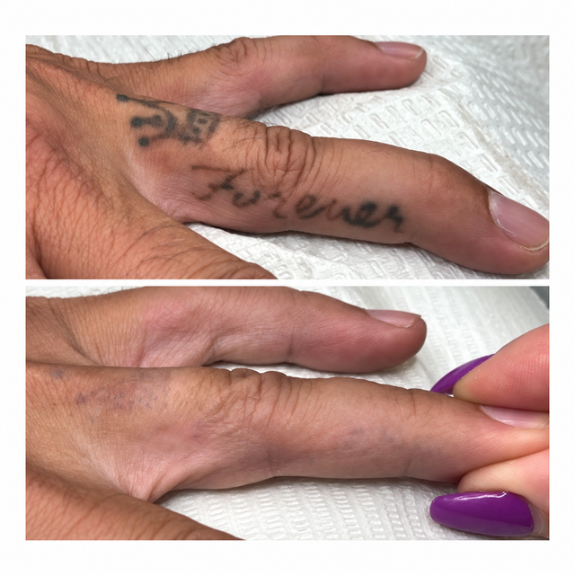 Laser handpiece positioned near an arm tattoo